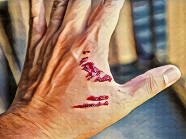 Focus dog bite wound and blood on hand