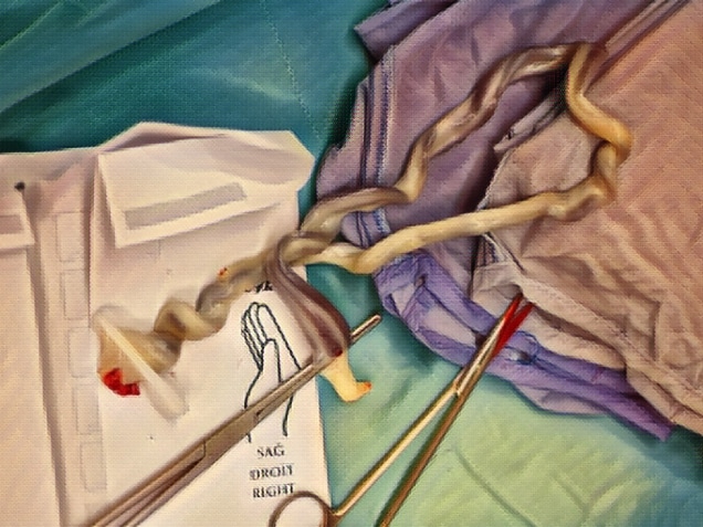 umbilical cord of a newborn baby