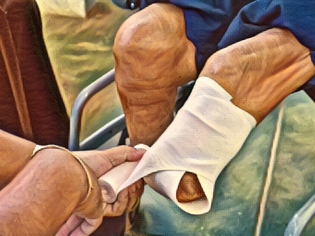 Elastic bandaging of below knee amputation