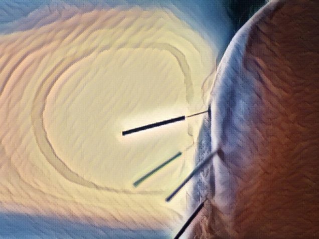 Dry needling acupunture needles used by acupunturist physiotherapist on patient in pain and injury treatment closeup macro photo.