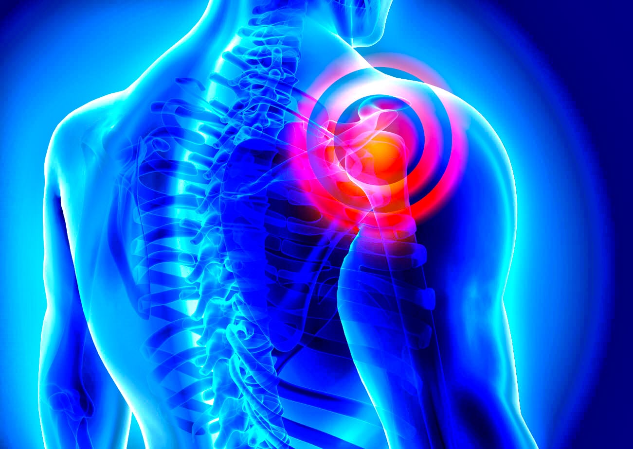 Workers Compensation for Scapula Strain
