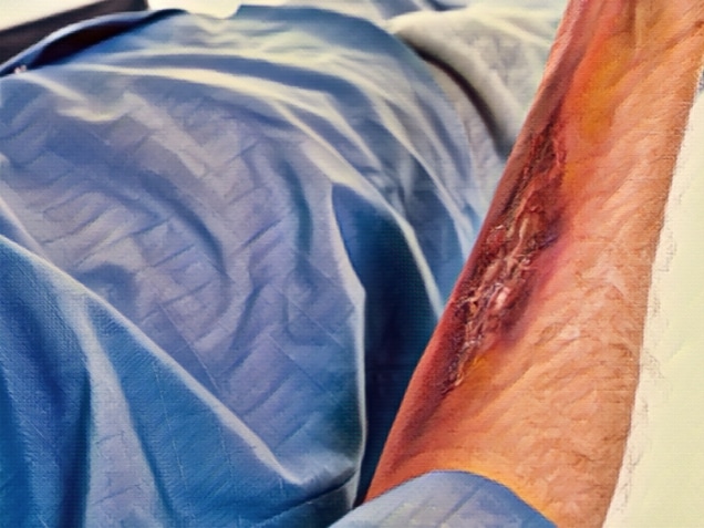 Serious burn injury on a man's arm